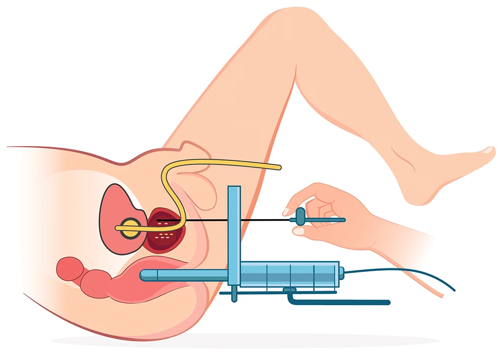 Eine schematische Darstellung einer LDR-Brachytherapie, wie sie bei Prostatakrebs beim CUROS urologischen Zentrum im Raum Köln/Bonn durchgeführt wird.